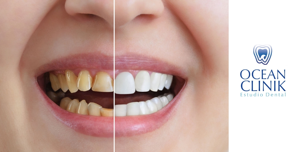 Carillas dentales: una solución rápida, eficaz y estética