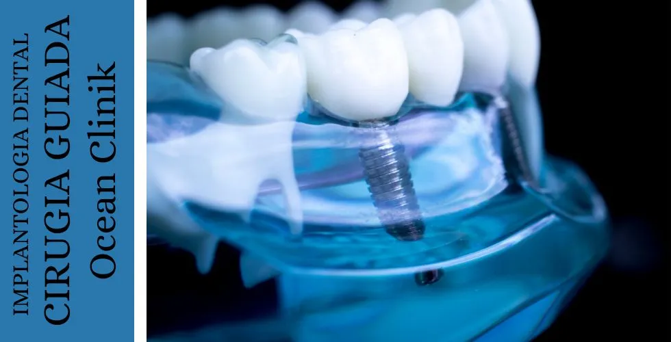 Recupera Tu Sonrisa: Mi Experiencia con los Implantes Dentales